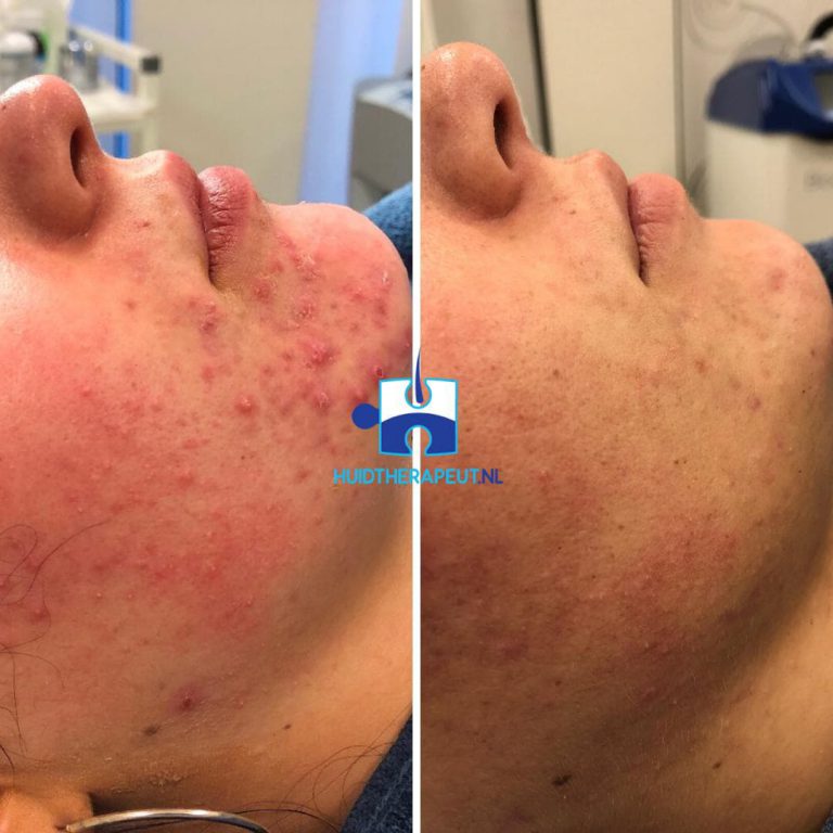 Acne behandeling - chemische peeling na zes behandelingen