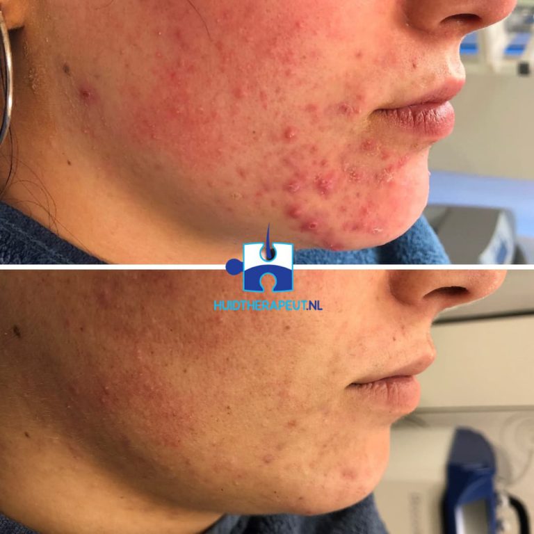 Acne chemische peelings