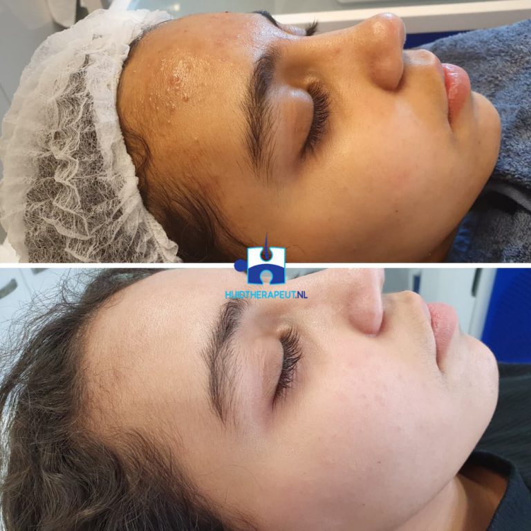 Acne behandeling - na vijf standaard acne behandelingen i.c.m. medicatie