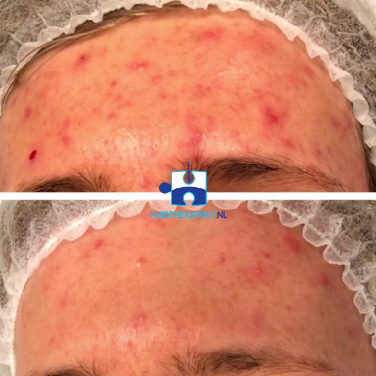 Acne behandeling - acne vulgaris