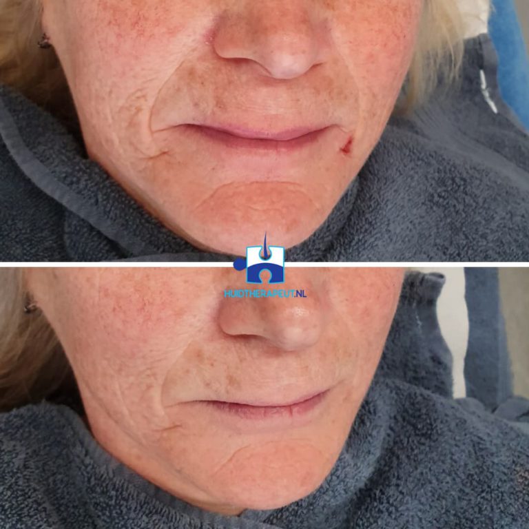 Skinrejuvenation - na drie behandelingen kin