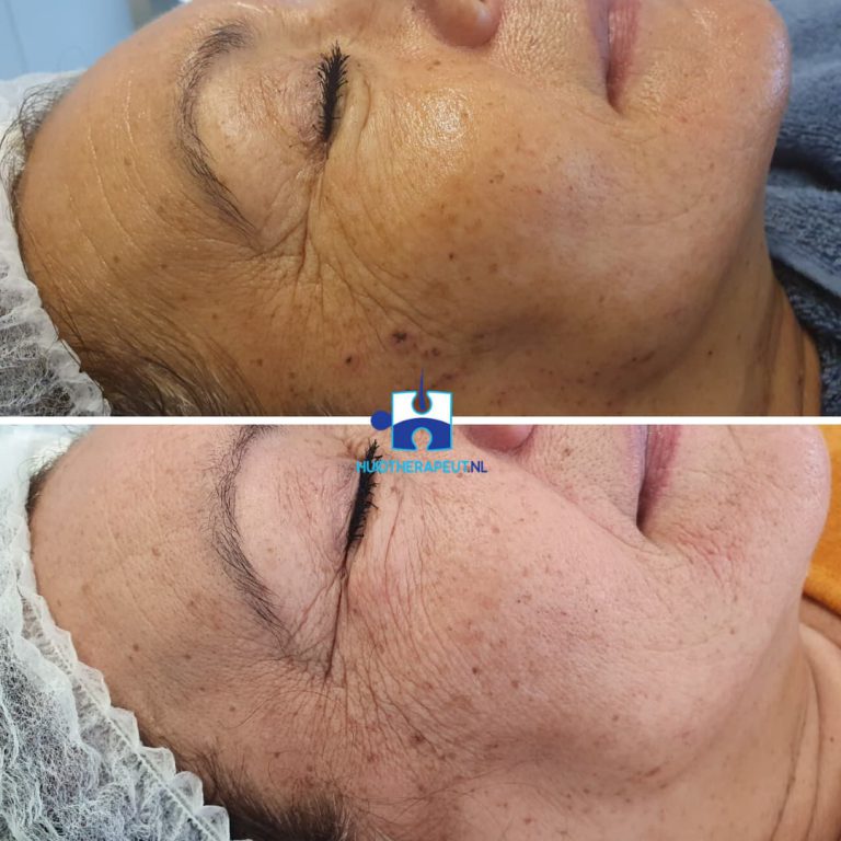 Skin rejuvenation- na drie behandelingen rechts