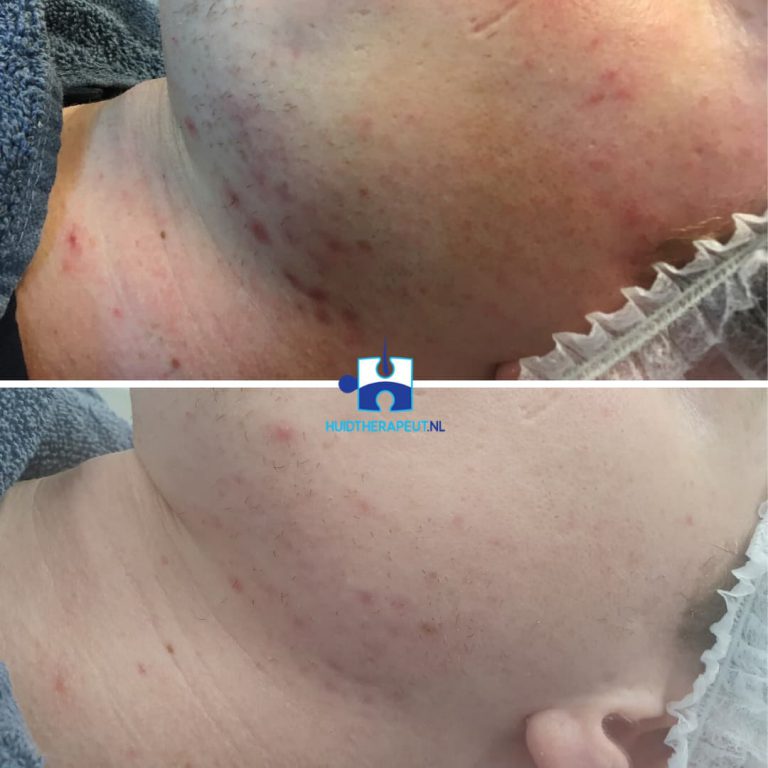 Chemische peeling - na vijf behandelingen - Acne littekens