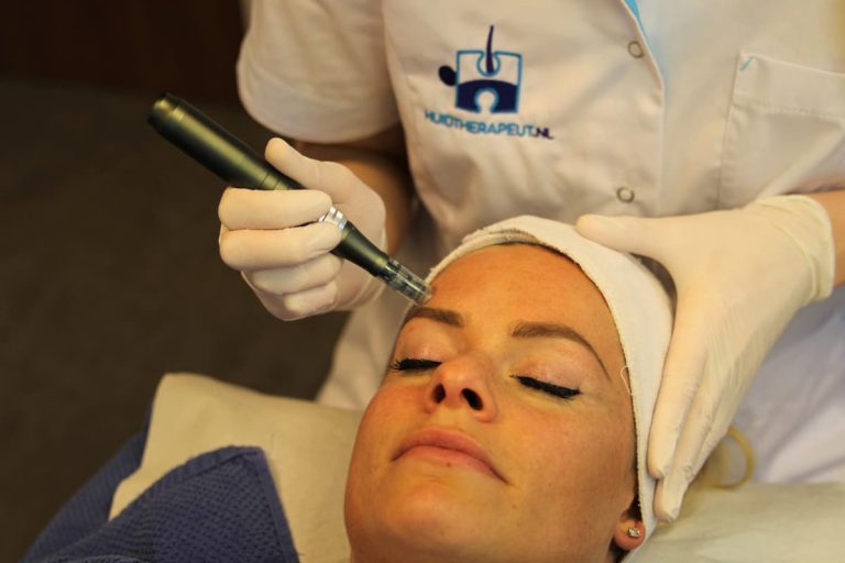 Behandelingen Microneedling Acne Littekens Grove Porien