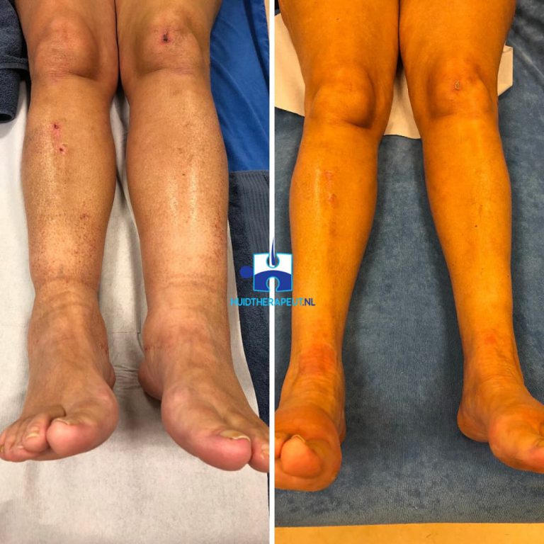 Behandelingen Oedeemtherapie - voor-na