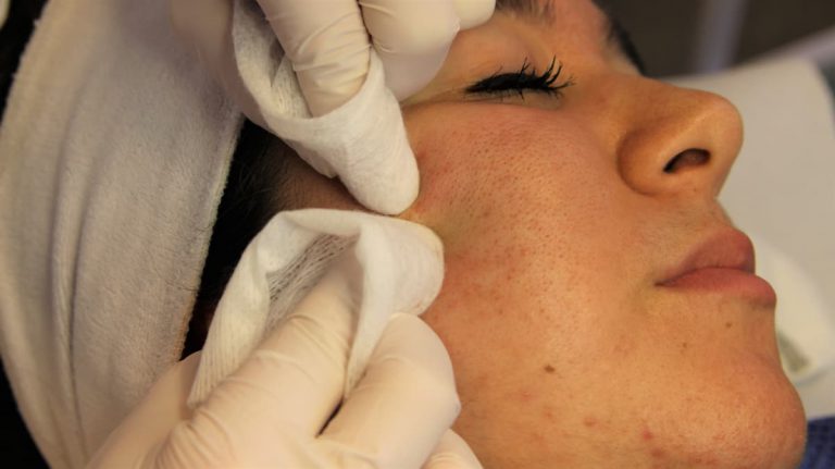 acne littekens behandeling