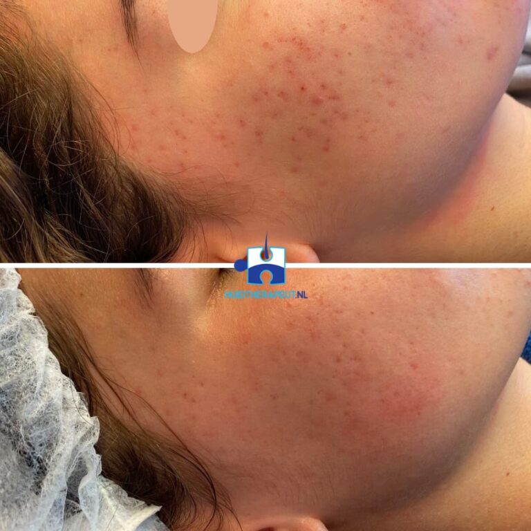 Acne behandeling - resultaat na vier behandelingen chemische peelings i.c.m. medicatie