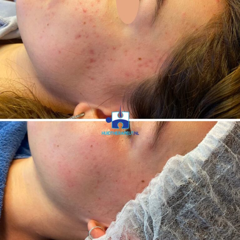 Acne behandeling wang - resultaat na vier behandelingen chemische peelings i.c.m. medicatie