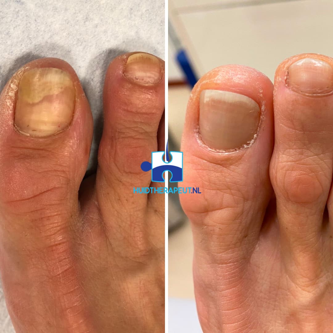 Onychomycosis - Nail fungus laser treatment - Hoogstra