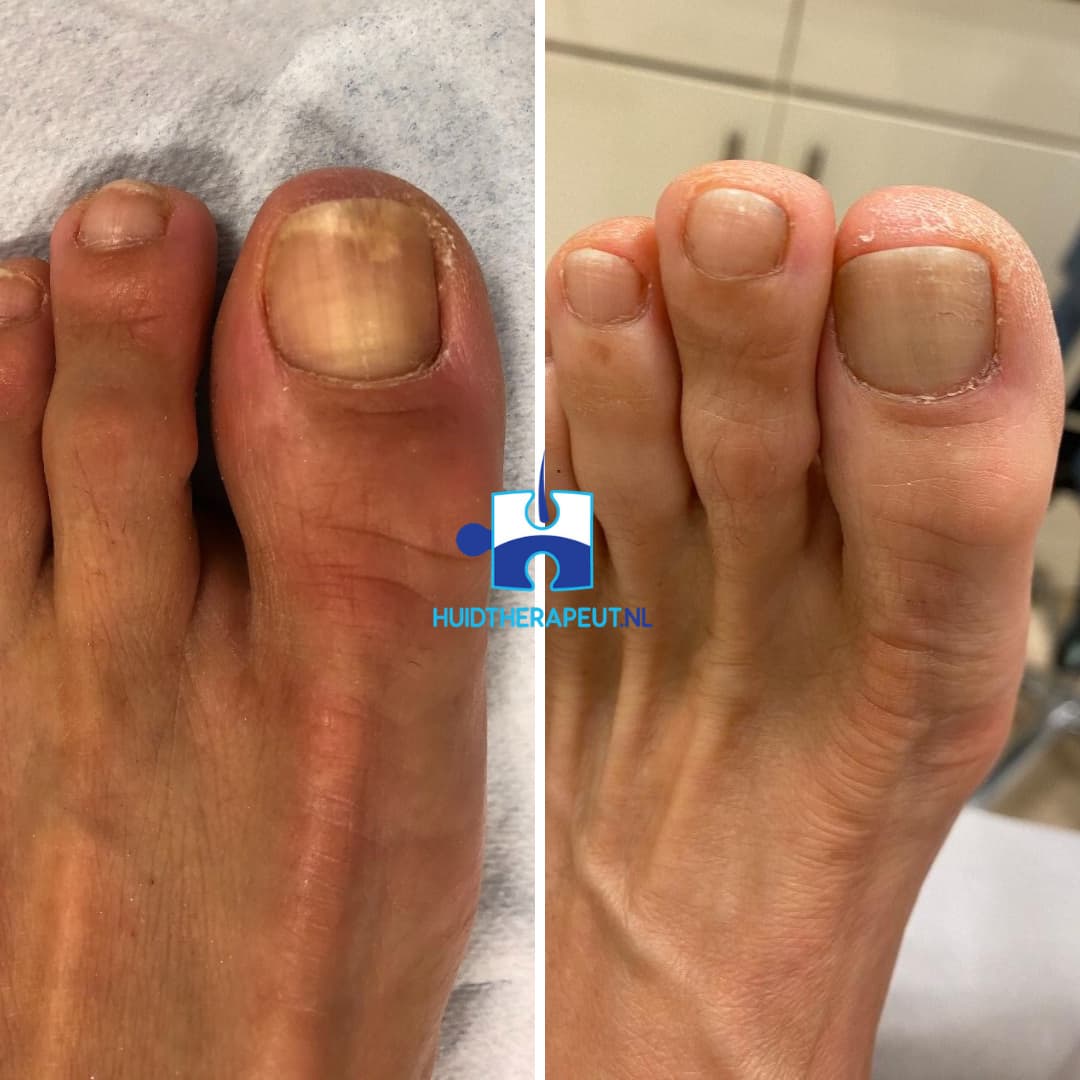 Nail Fungus Laser Treatment - Top Dermatologist in San Antonio Boerne |  Texas Institute of Dermatology, Laser and Cosmetic Surgery