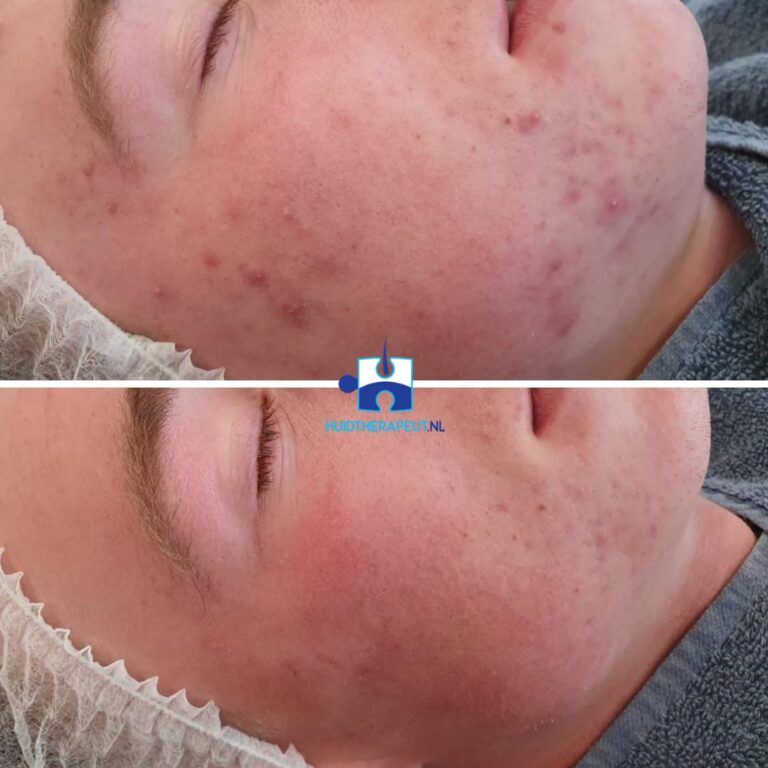 Acne littekens na 3 behandelingen chemische peelings