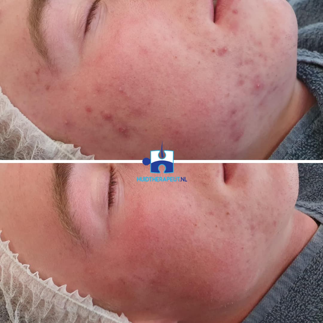 Vloeibaar Dank u voor uw hulp Misbruik Chemische peeling - Gratis consult - Uw huid, onze zorg - Huidtherapeut NL