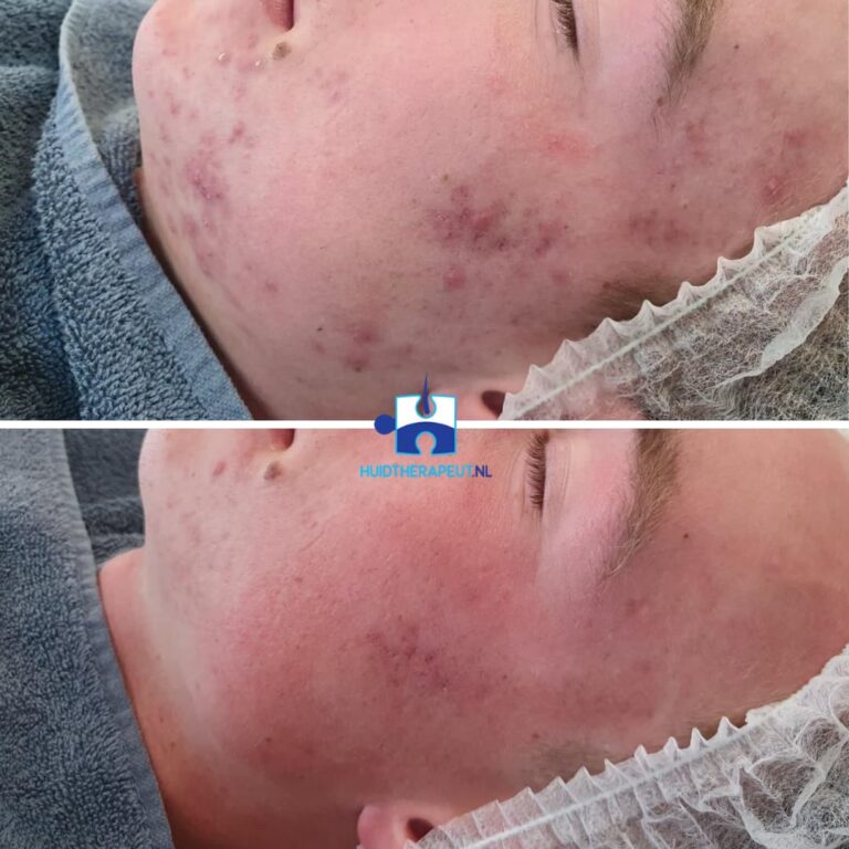 Acne littekens na 3 behandelingen chemische peelings