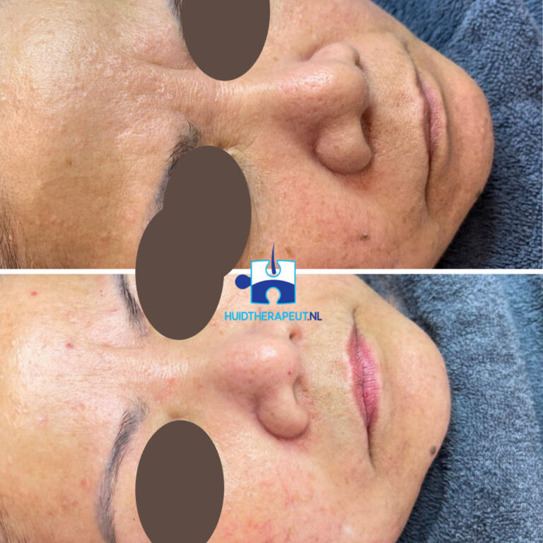 Huidverbetering na microneedling + chemische peeling