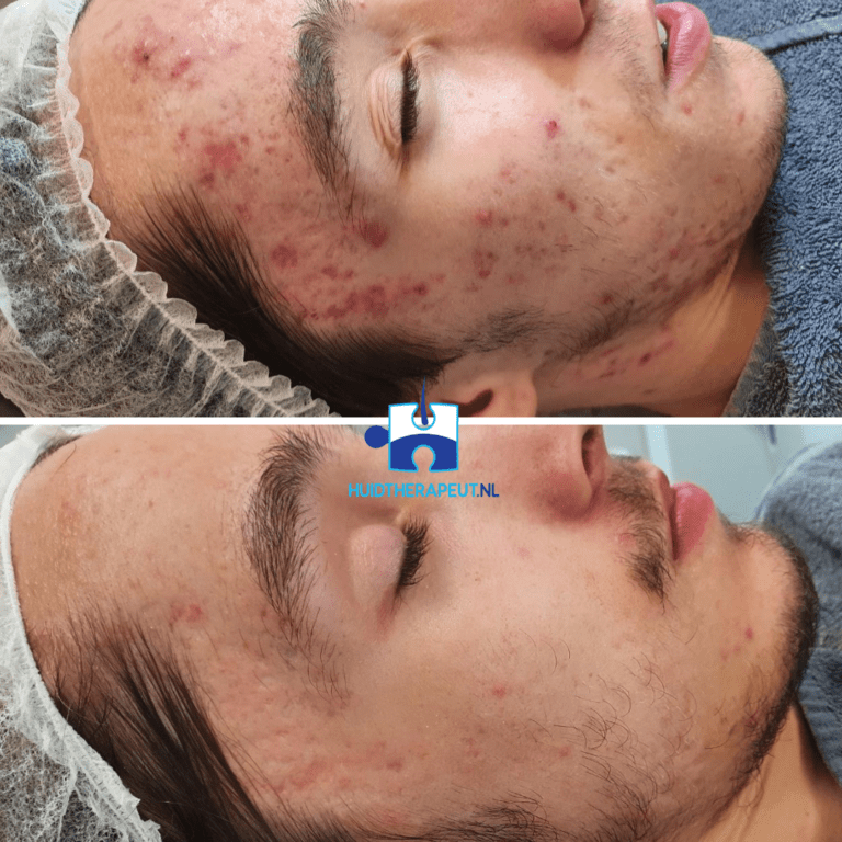 Acne - chemische peeling behandeling - resultaat na 6 behandelingen