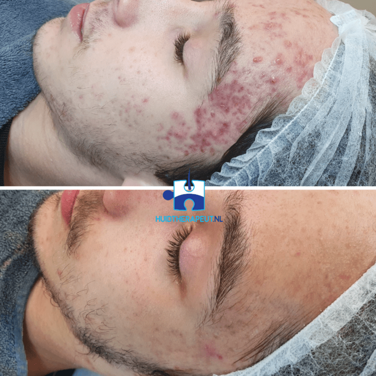 Acne - chemische peeling behandeling - resultaat na 6 behandelingen