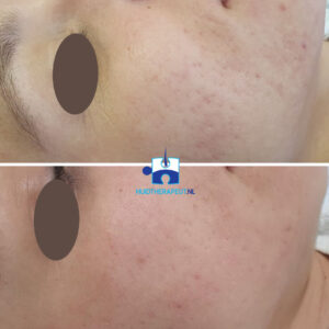 Acne-littekens - Resultaat na 5 microneedling behandelingen