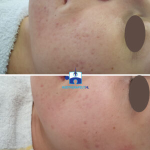 Acne-littekens - Resultaat na 5 microneedling behandelingen