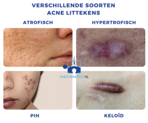 Littekenbehandeling acne soorten