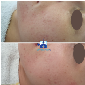 Littekenbehandeling acne