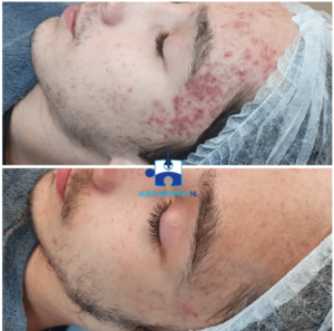 Littekenbehandeling acne