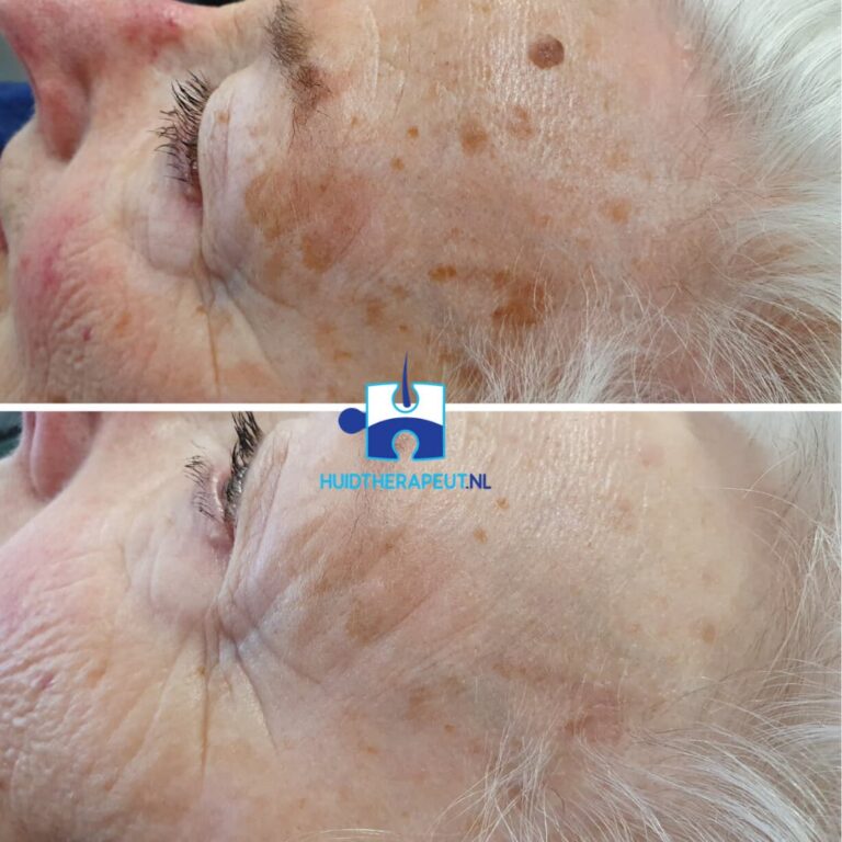 Cryotherapie